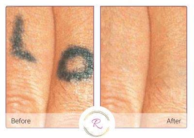 Laser Tattoo Removal Before and After of Hand Tattoos