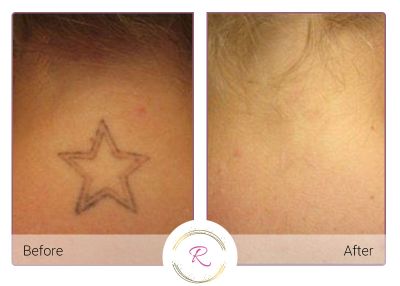 Laser Tattoo Removal Before and After of neck tattoo