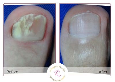 Nail Fungus before and after on big toe